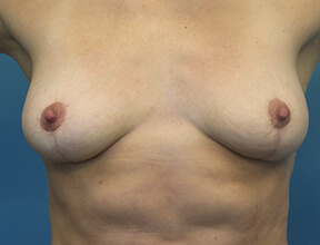 Breast Implant Exchange After